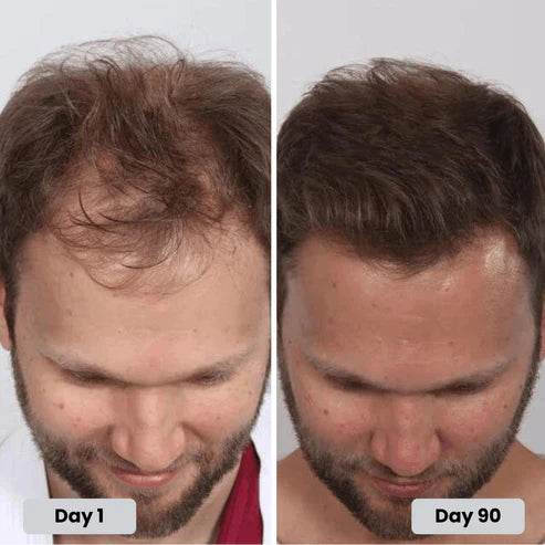 ed Light Therapy Cap for Hair Regrowth ✨🧢