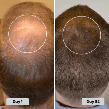 ed Light Therapy Cap for Hair Regrowth ✨🧢