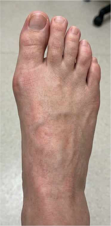 Adjustable Bunion Corrector Brace