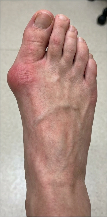 Adjustable Bunion Corrector Brace