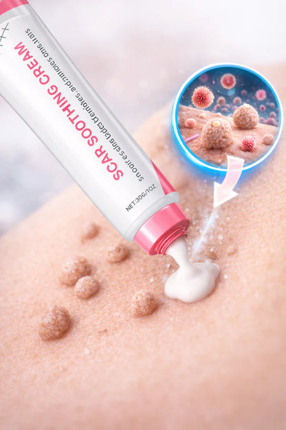Scar free wart removal cream