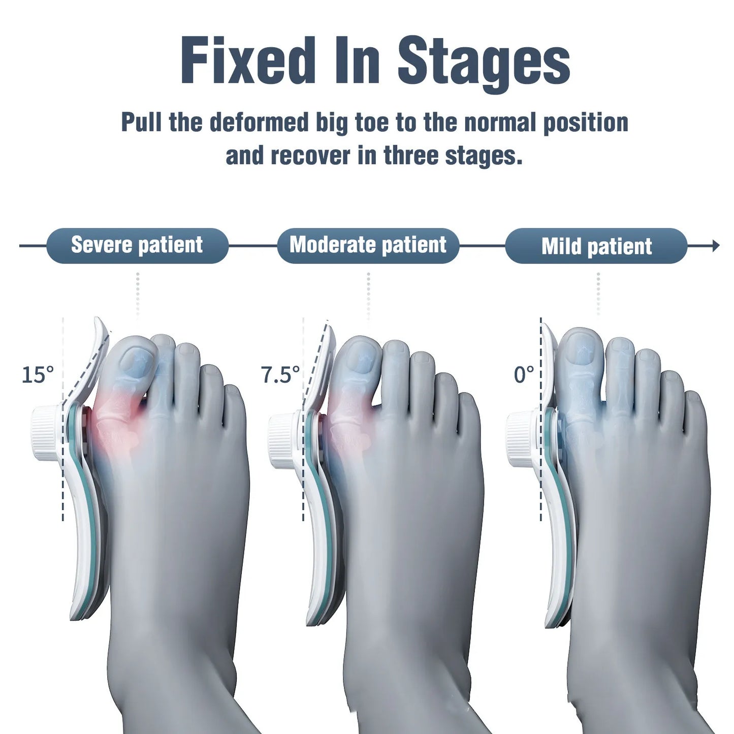 New Men's And Women's 3-board Correction Varying Degrees Thumb Valgus Orthosis