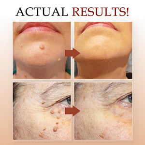 🎁CC™ Tags & Moles Remover