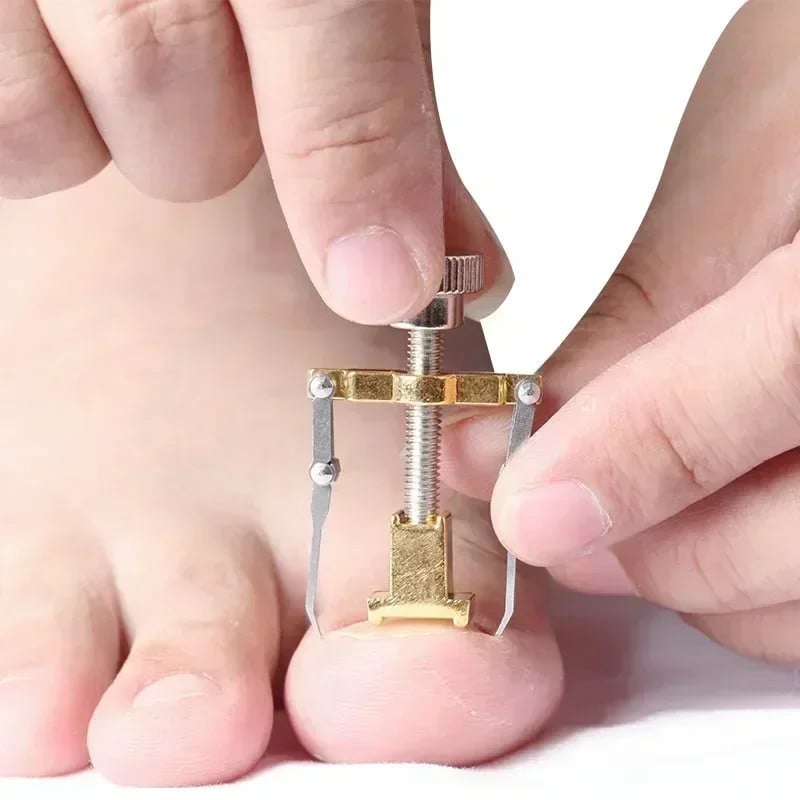 Ingrown Toenail Corrector Tool