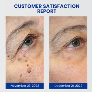 Instant Blemish Removal Cream