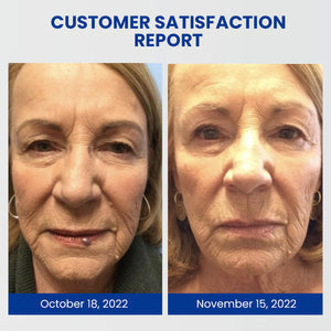 Instant Blemish Removal Cream