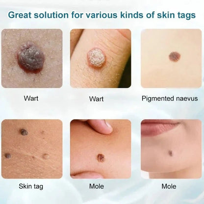 🔥LAST DAY 50% OFF🔥 - SEAGRIL-Concentrated Potent Skin Tag Removal Cream