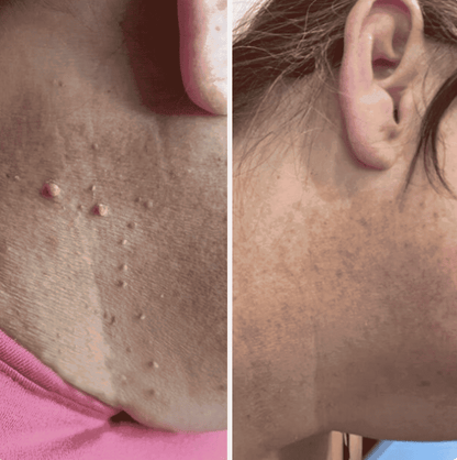 ClearBand™ Skin Tag Banding Kit