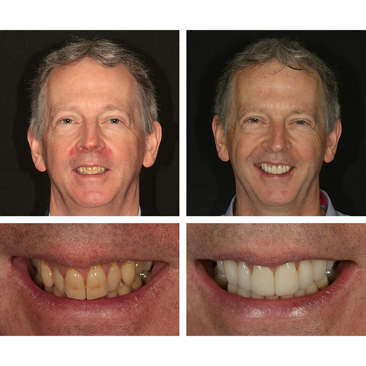 LANTHOME™ Teeth Whitening Essence