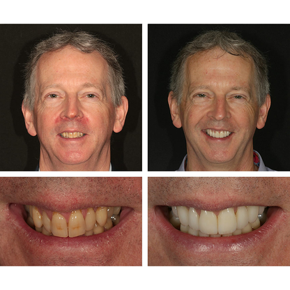 LANTHOME™ Teeth Whitening Essence