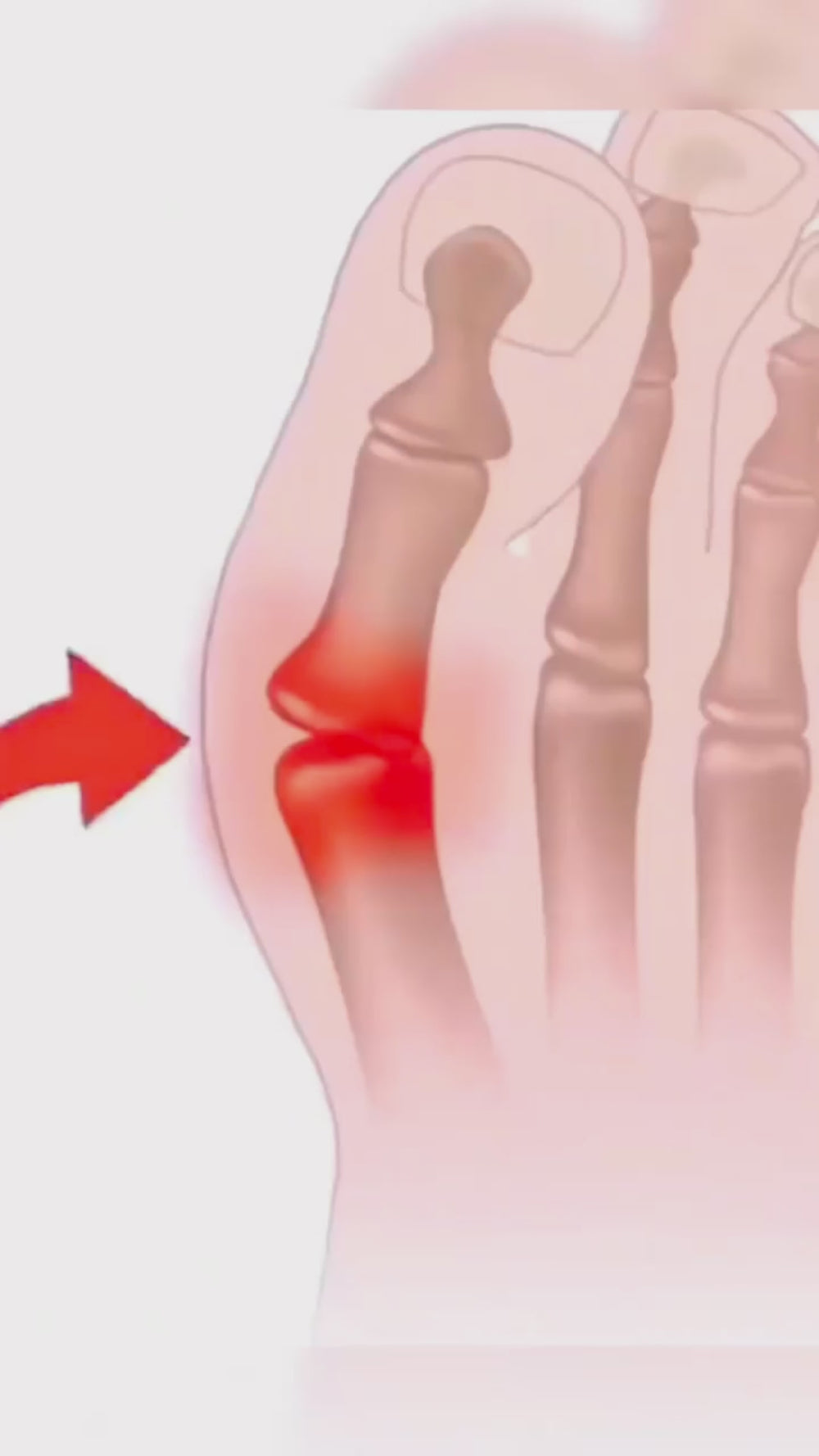Adjustable Bunion Corrector Brace