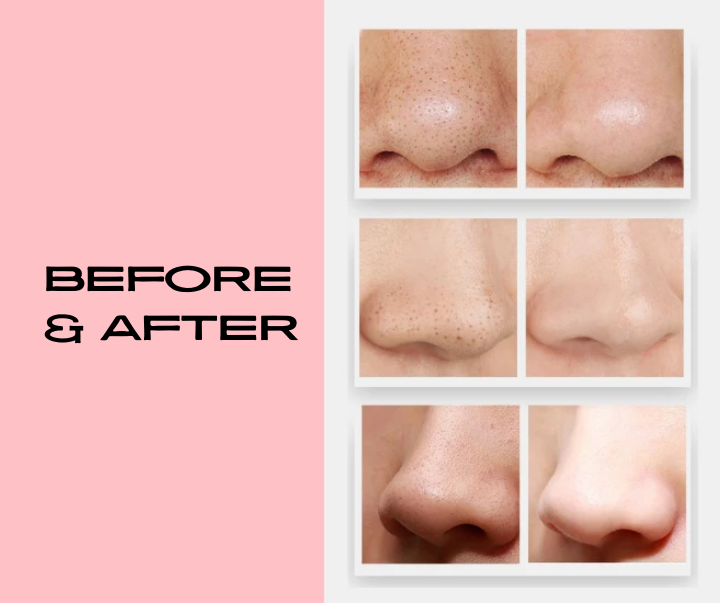 PureGlow Vacuum Pore Cleaner – Deep Cleansing Blackhead Remover for Clearer Skin